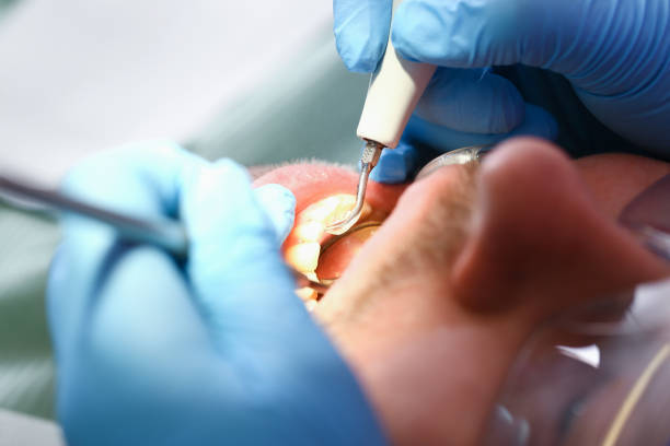 Best Urgent Care for Lost Fillings or Crowns in Hico, TX