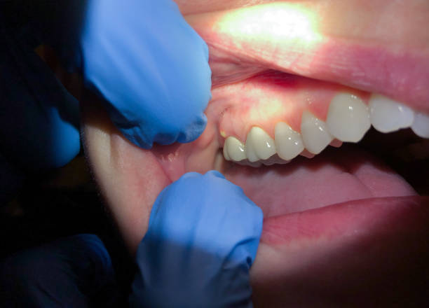 Best Emergency Dental Care for Broken or Chipped Teeth in Hico, TX
